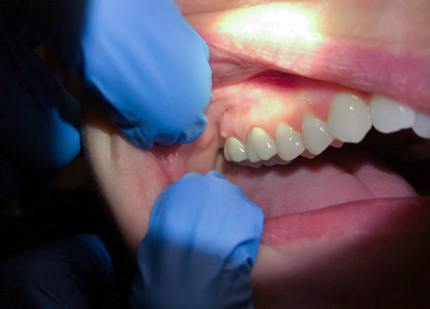 Best Knocked-Out Tooth (Avulsed Tooth) Treatment in Paonia, CO